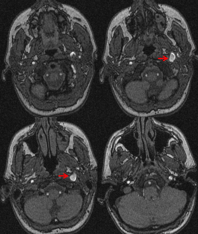 Pulsatile Tinnitus Carotid Artery Dissection 0338